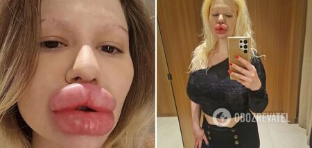 Kobieta z największymi ustami na świecie miała 6 'zastrzyków upiększających' w ciągu jednego dnia, mimo że lekarze ostrzegali, że jej ciało zacznie gnić. Zdjęcie