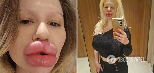 Kobieta z największymi ustami na świecie miała 6 'zastrzyków upiększających' w ciągu jednego dnia, mimo że lekarze ostrzegali, że jej ciało zacznie gnić. Zdjęcie