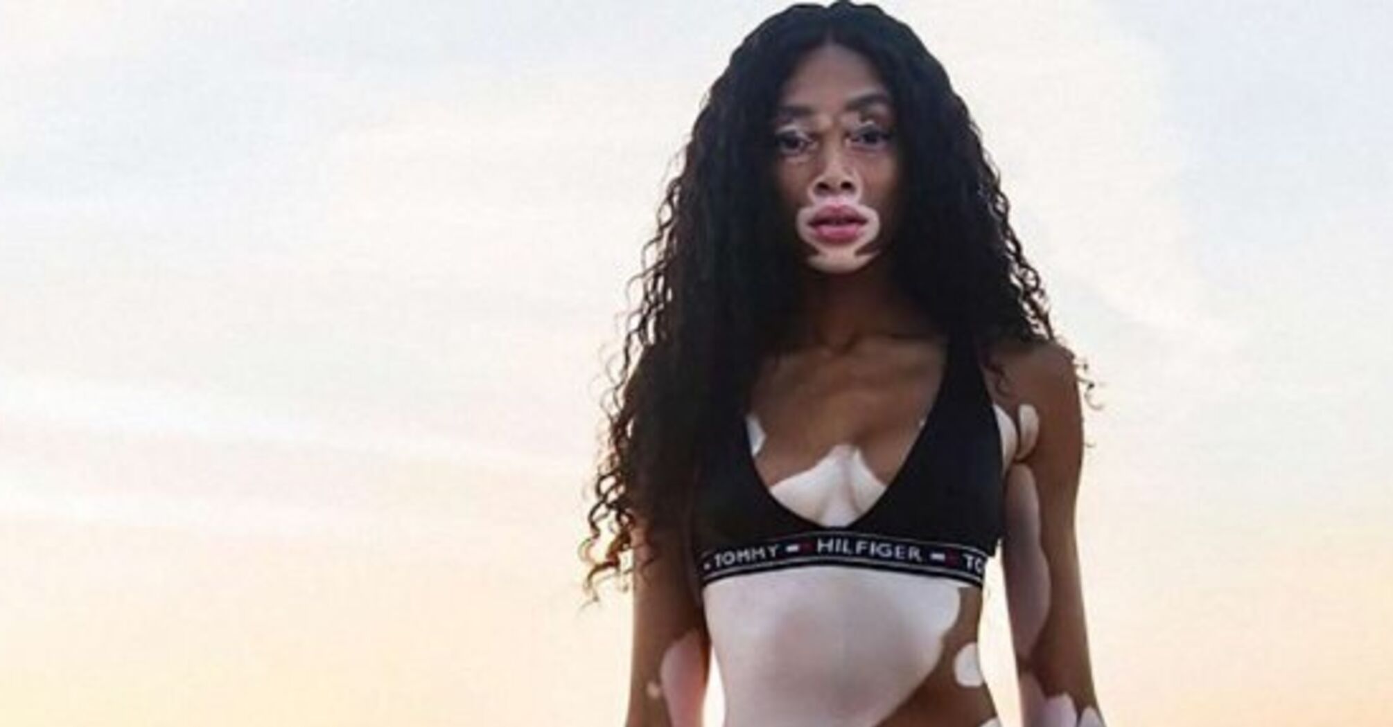 Витилиго: изюминка или проклятие?