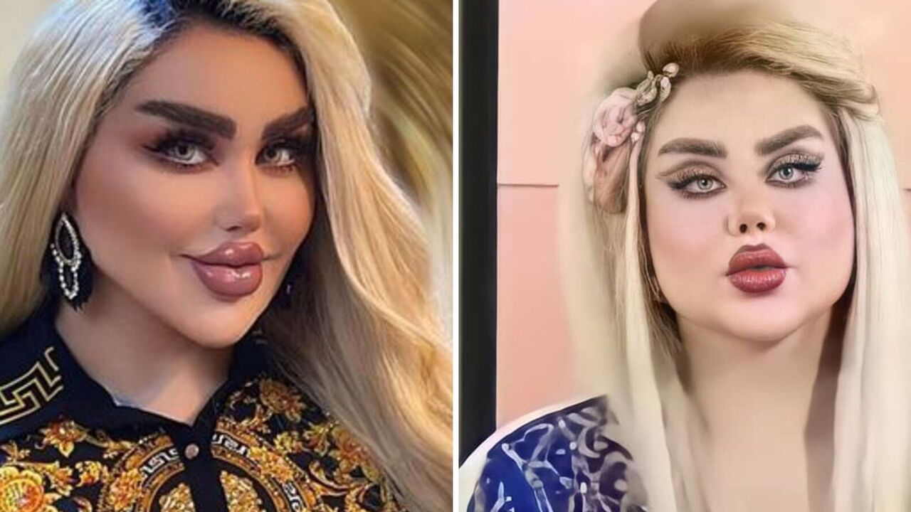 Iraqi woman underwent 43 surgeries to look like a Barbie doll: here's how it turned out