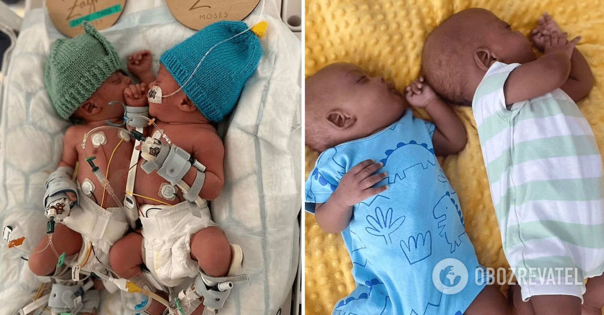 Siamese twins from London, who were separated at three months old, celebrated their first birthday. What Zayne and Zion look like now
