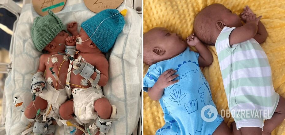 Siamese twins from London, who were separated at three months old, celebrated their first birthday. What Zayne and Zion look like now