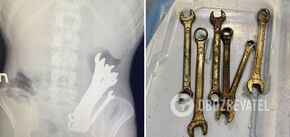 W Czerkasach lekarze uratowali pacjenta, w którego żołądku znajdowało się sześć kluczy. Zdjęcie