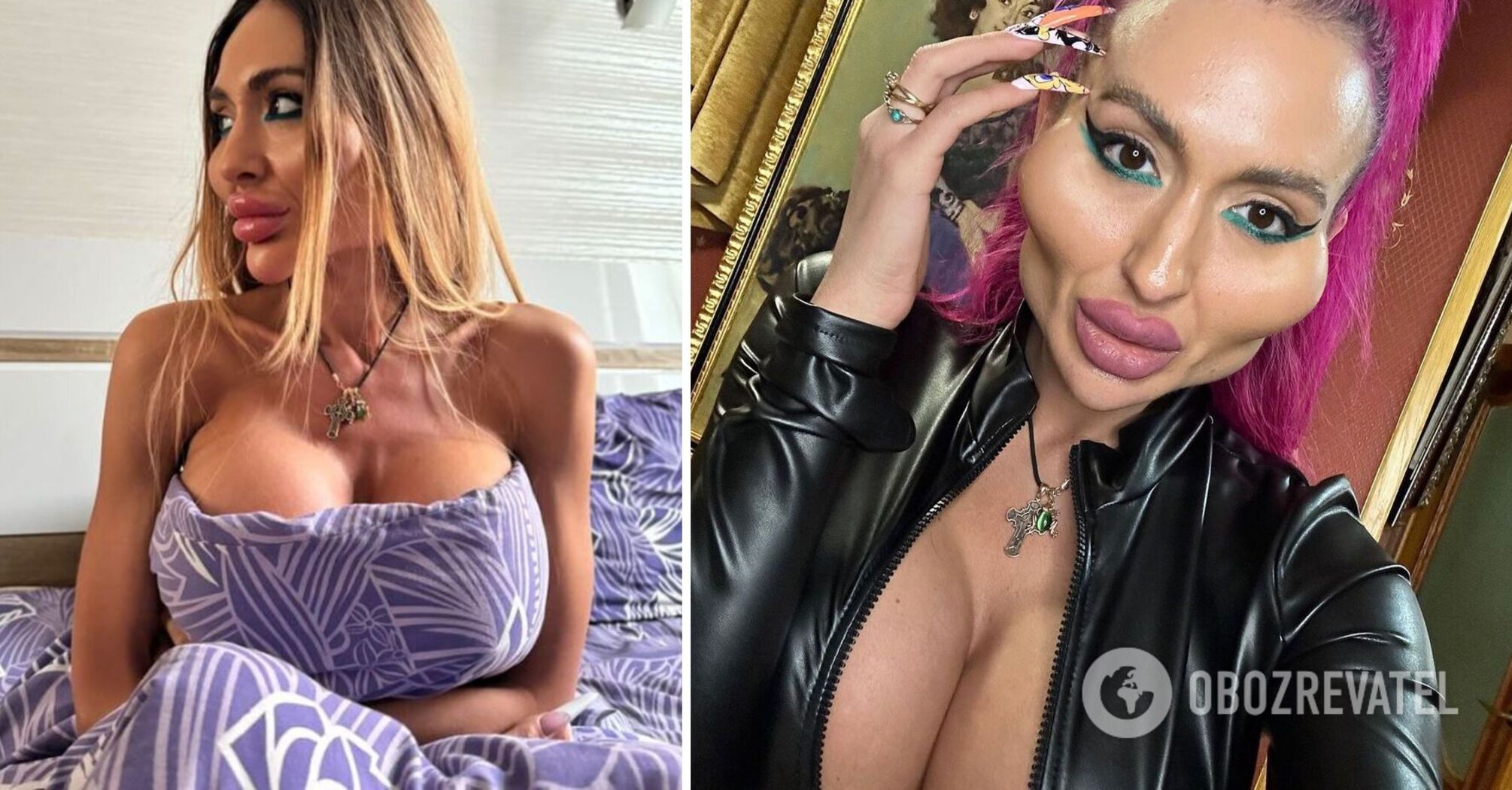"I wanted a bigger size". Ukrainian plastic surgery queen tells about three breast surgeries and a 6-hour surgery